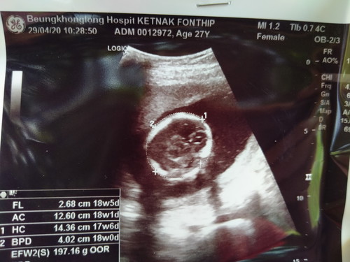 อันตร้าซาว ที่หมอให้ 18w. นี้คือตรงใช่ไหมคะ