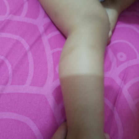 cara mengatasi hitam bekas gigitan nyamuk