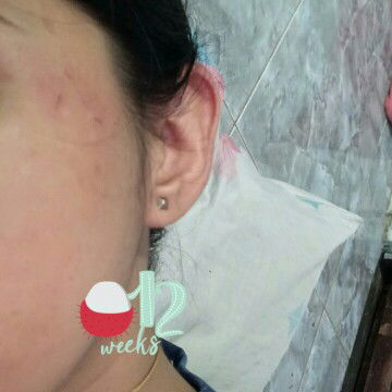 gatal gatal area muka