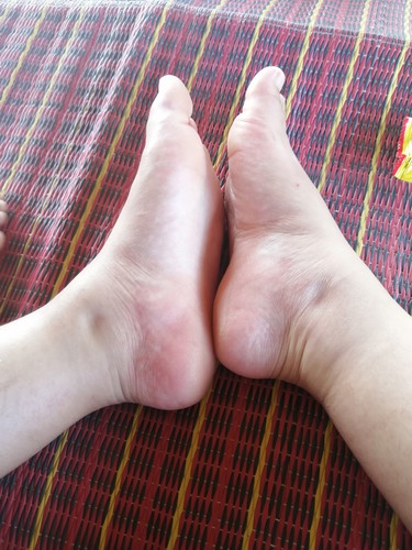 เท้าบวม
