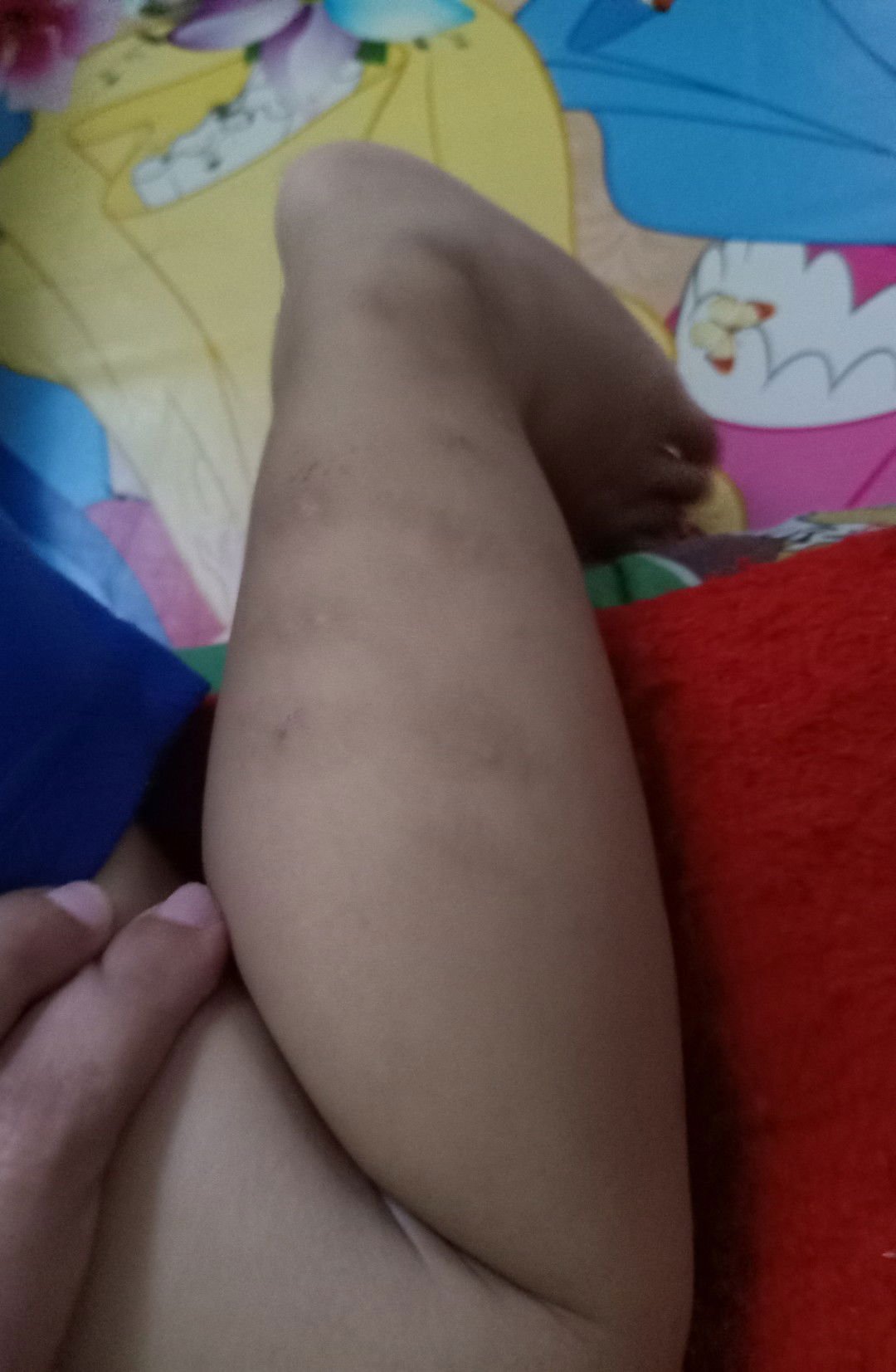 ngilangin bekas luka dan gigitan serangga