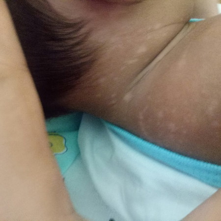 White patches on my baby's neck