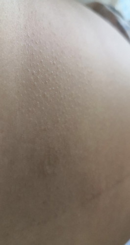 Spot Chicken Skin?