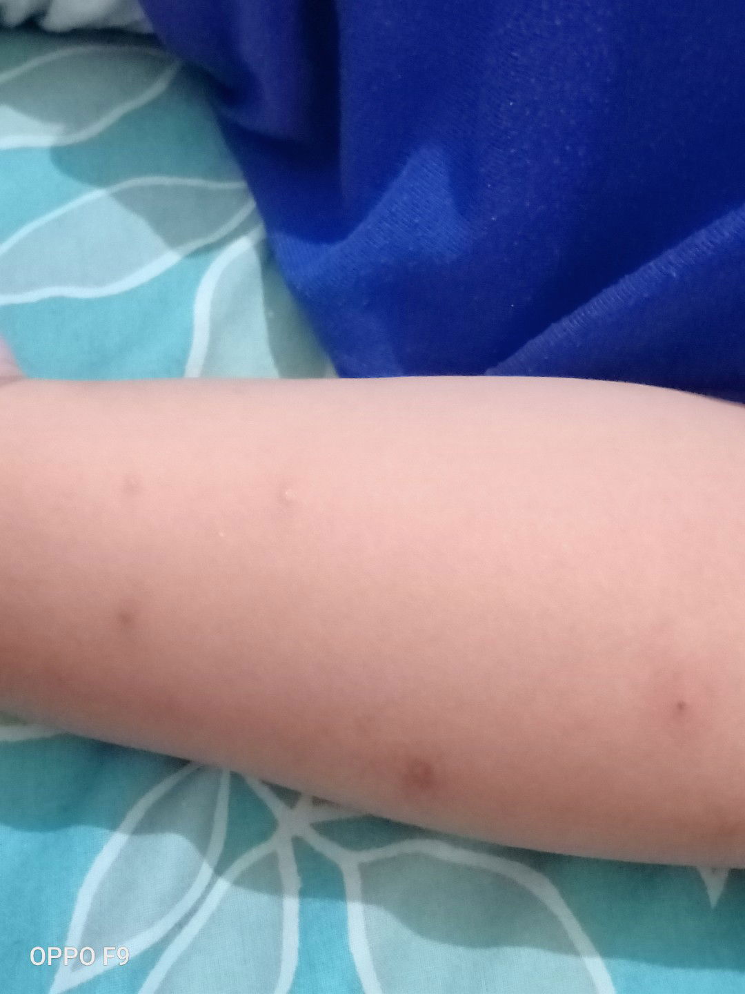 Menghilangkan bekas gigitan nyamuk