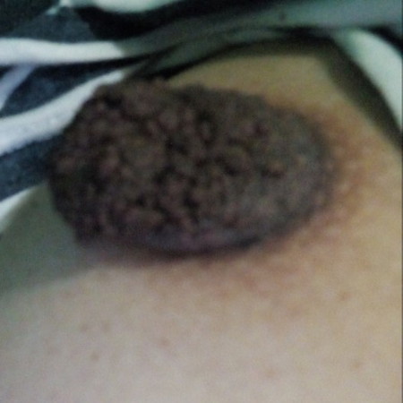 nipple problem?? HELP! Sorry sa picture?? SPG?