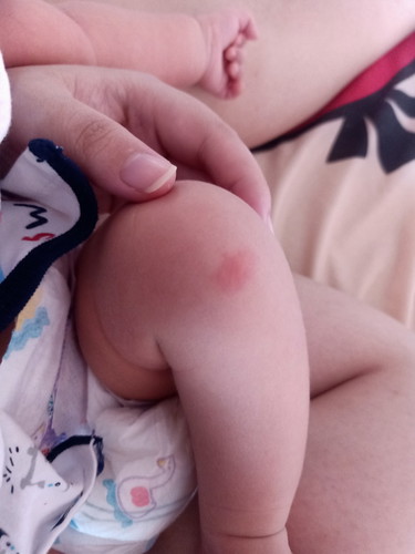 เวลาลูกโดนยุงกัด แม่ๆ ใช้อะไรทาให้ลูกคะ?