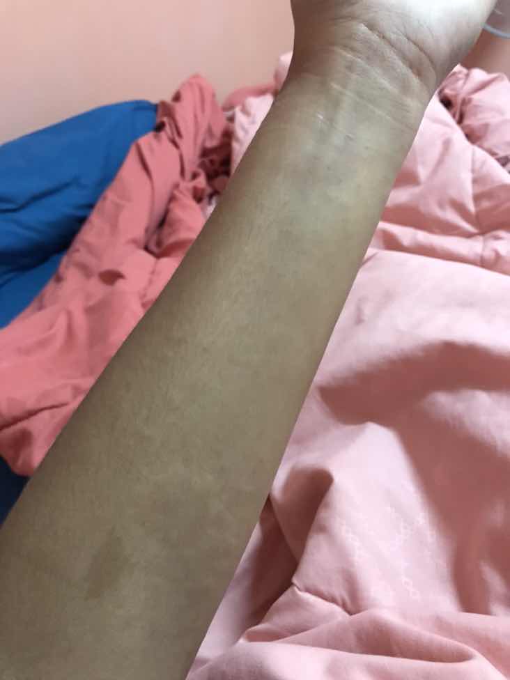 มีผื่นขึ้น