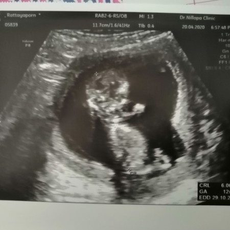 แม่ๆมีวิธีเดาเพศลูกในท้องกันมั้ยคะ