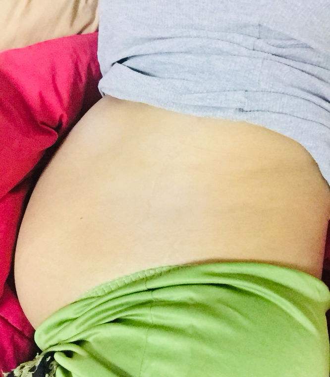 มีแม่ๆท่านไหน เจ็บซี่โครง บ้างใหมค่ะ ไม่รู้ว่าเกิดจากที่ตัวเล็กดันหรือดิ้นใหม