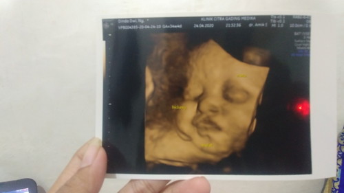 Kelainan Bawaan Lahir Gastrochichis