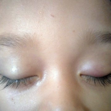 mata agak bengal sebelah