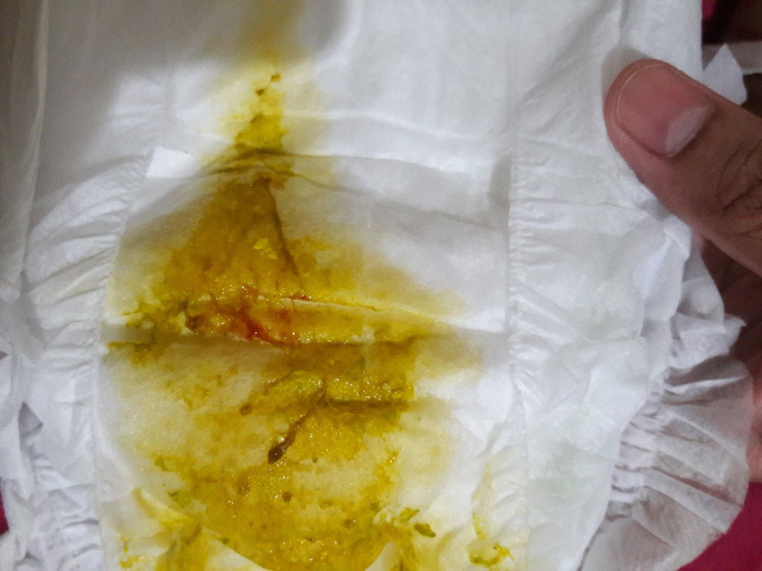 Bayi 2 bulan BAB bercak darah