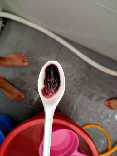 threatened miscarriage