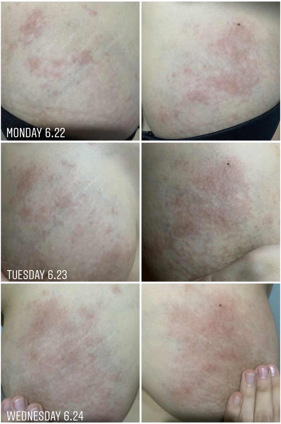 Pregnancy Rashes? PUPPP?