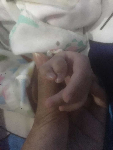 นิ้วก้ามปู