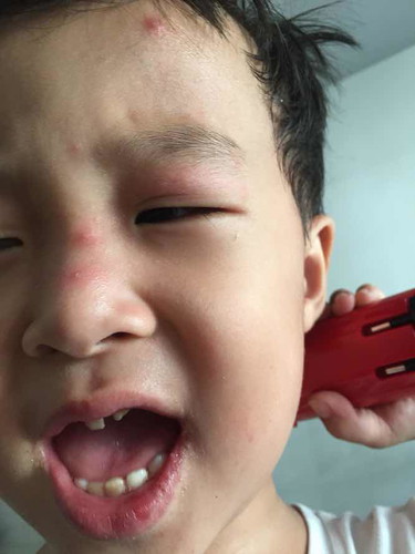 Con mình 4 tuổi , cách nay 2 ngày bé bị nổi trên mặt, miệng như vậy là bệnh gì vậy?
