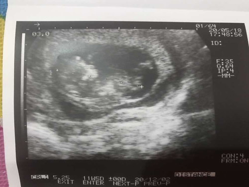 ท้องแฝด แต่ใข่ฝ่อ 1 ใบ