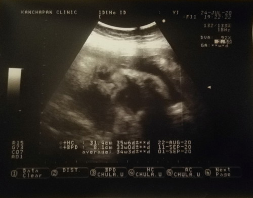 ตั้งครรภ์