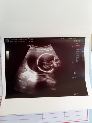 น้ำในสมองลูกน้อย
