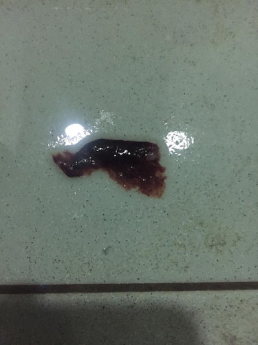 Kenapa ya bleeding keluar jelly? Usia kandungan 6week 4days. Tanda tanda keguguran ke ni ???
