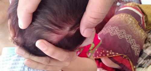 benjolan di kepala bayi