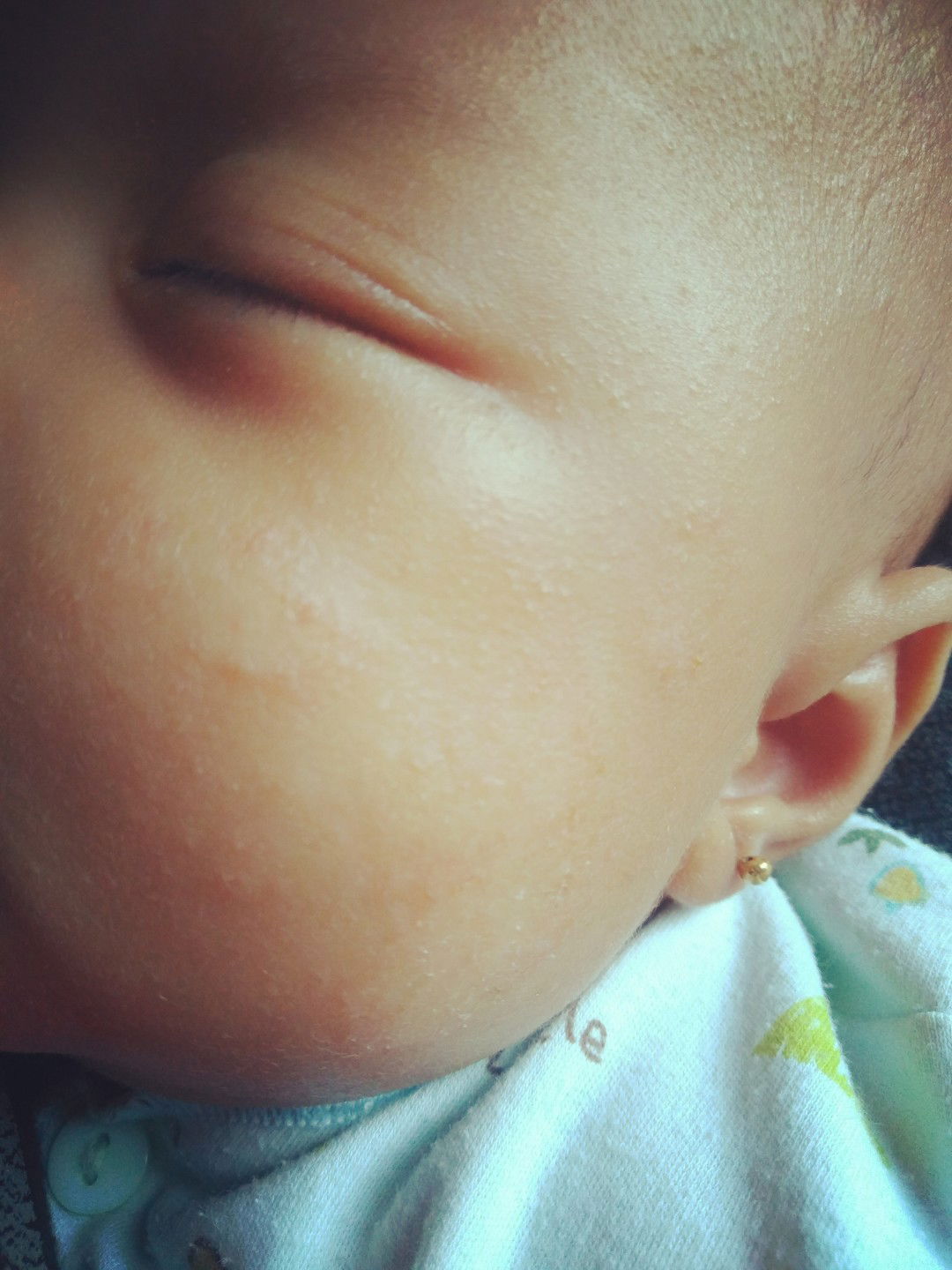 yang ginikah yang namanya ruam?