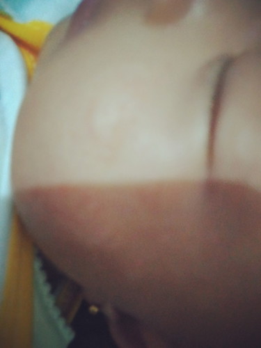 ruam di pipi