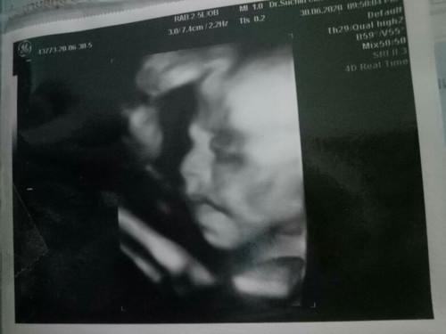 24W5d