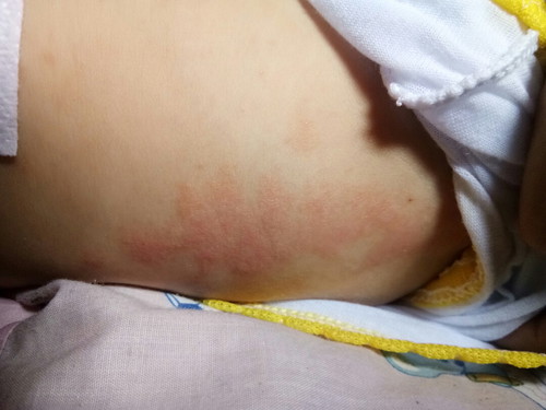 rashes