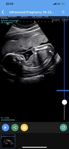 แม่ๆ ช่วยดูหน่อยได้ไหมคะ ได้น้องผู้หญิง หรือผู้ชายคะ น้อง 22 วีค