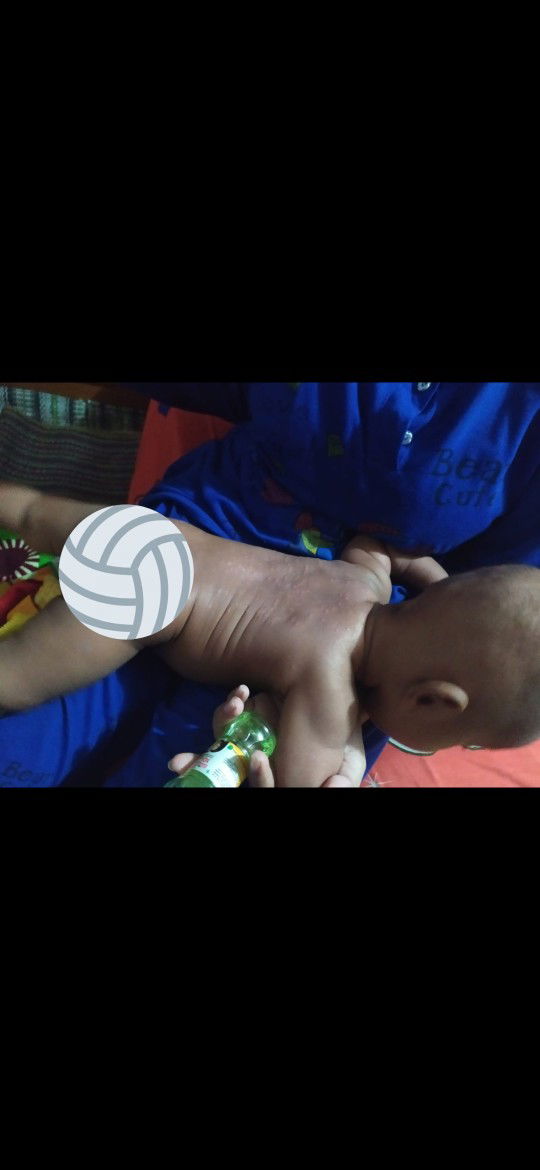 gatal merah di area punggung bayi