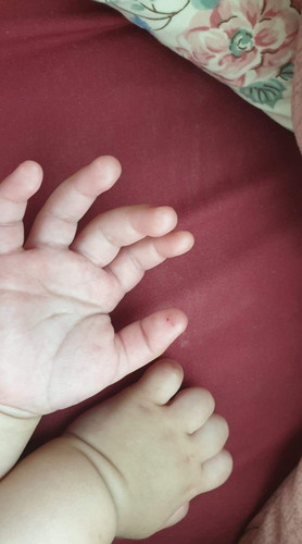 ลูกหกเดือนโดนกระรอกข่วนนิ้มมือต้องไหหาหมอไหม