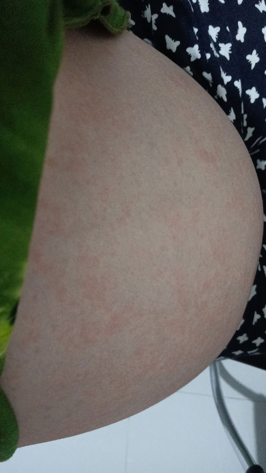 Ruam merah tidak gatal usia kehamilan 22W