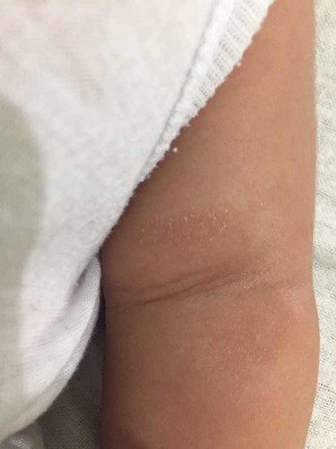 Dry skin