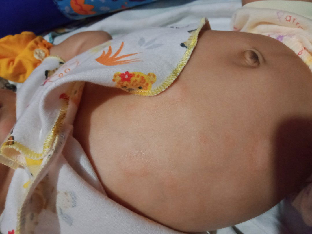 gatal pada bayi 2 bulan