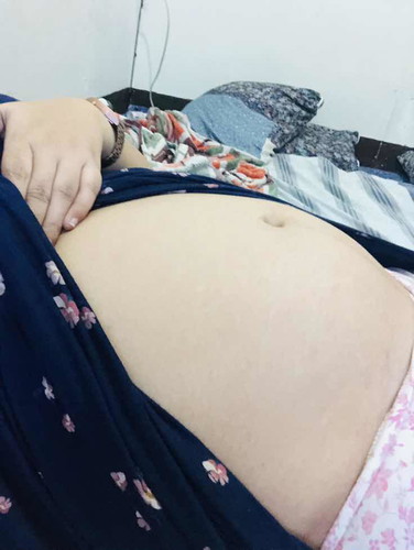 Stretch marks