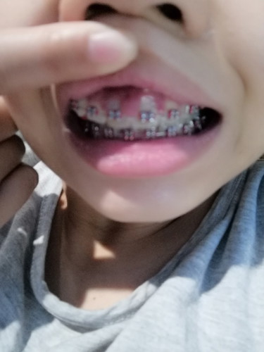 Gums