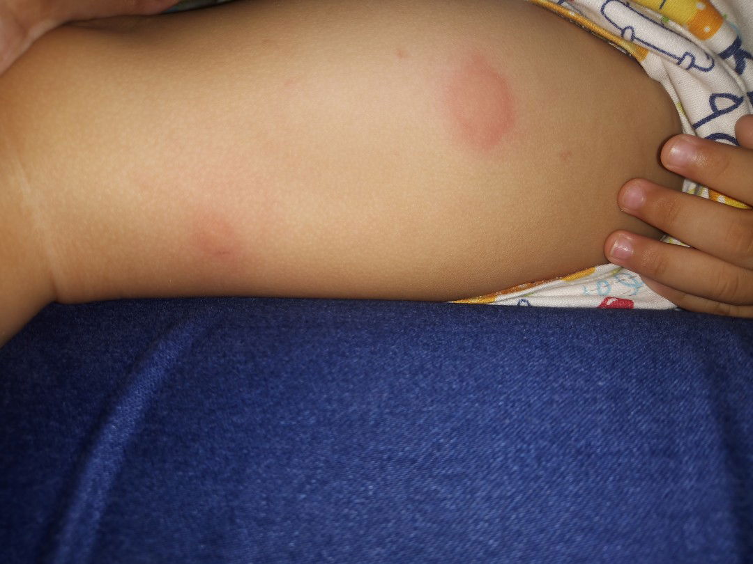 bentolbentol dikaki anak