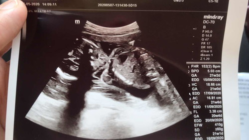 Siapa boleh agak baby girl or boy?