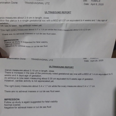 Expecting for fetal cardiac activity