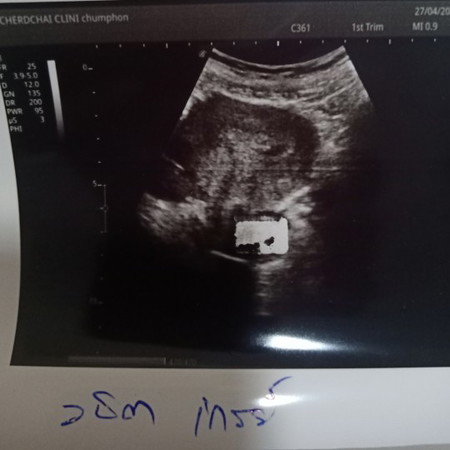 5วีค3วัน สรุปท้องนอกมดลูกหรือท้องปกติกันแน่