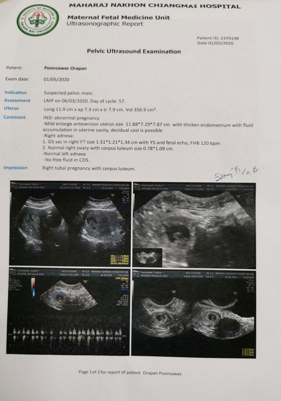 ประสบการณ์ท้องนอกมดลูก​ ครั้งที่​ 2 ครั้งแรกท้องลมแล้วหลุดไป