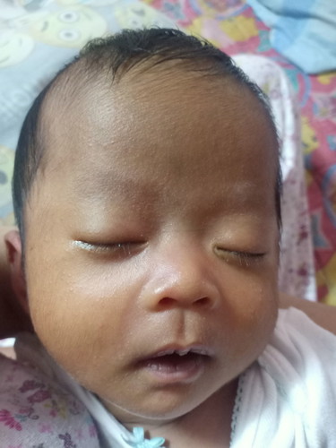 rashes sa face ni baby
