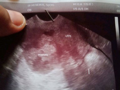 di USG ga hamil