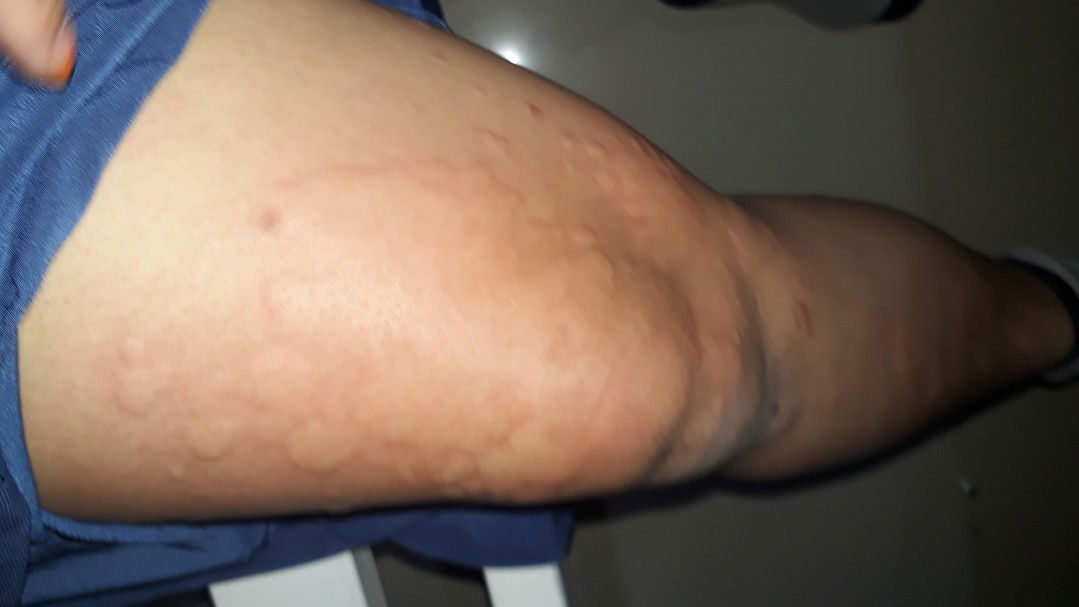 urtikari selama kehamilan