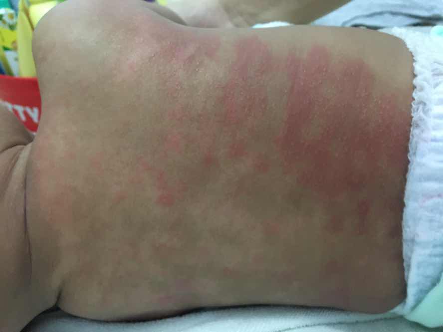 Kulit kering, mengelupas, dan berbintik