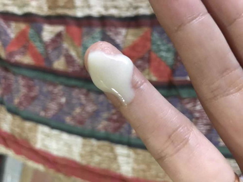 Milk like discharge