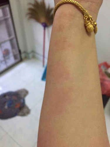 ผื่นคันทัองจะได้5เดือนแร้วคร้า