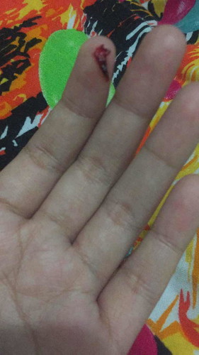 Flek yg ditakutkan malah terjadi???