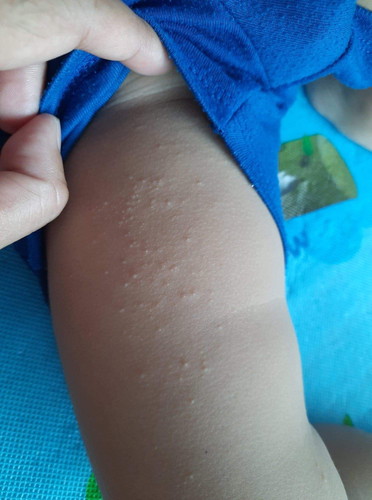 ผื่นแบบนี้คือแพ้อะไรค่ะ